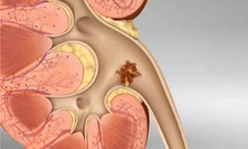 Mesane Taşı Kullanımı ve Faydaları Nelerdir?